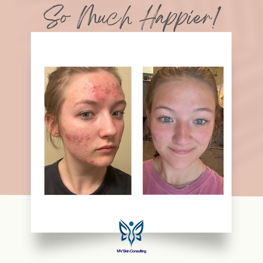 Healing acne is easy when you understand the reason and location it shows up, by MV Skin Consulting - Richardson