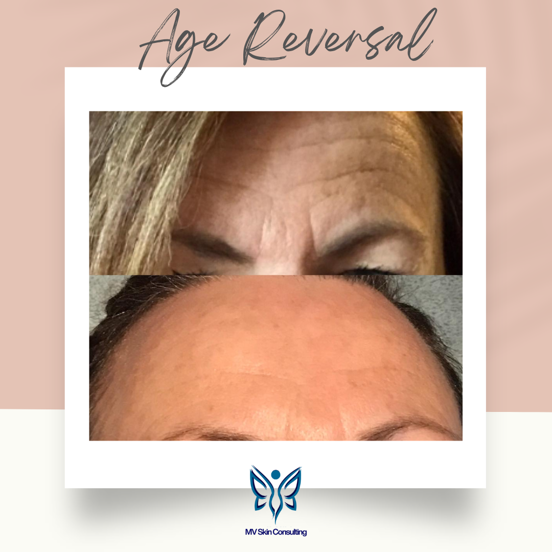 Near North Dallas, Age Reversal Facials by MV Skin Consulting corrected lines and wrinkles without needles, harsh products, or downtime
