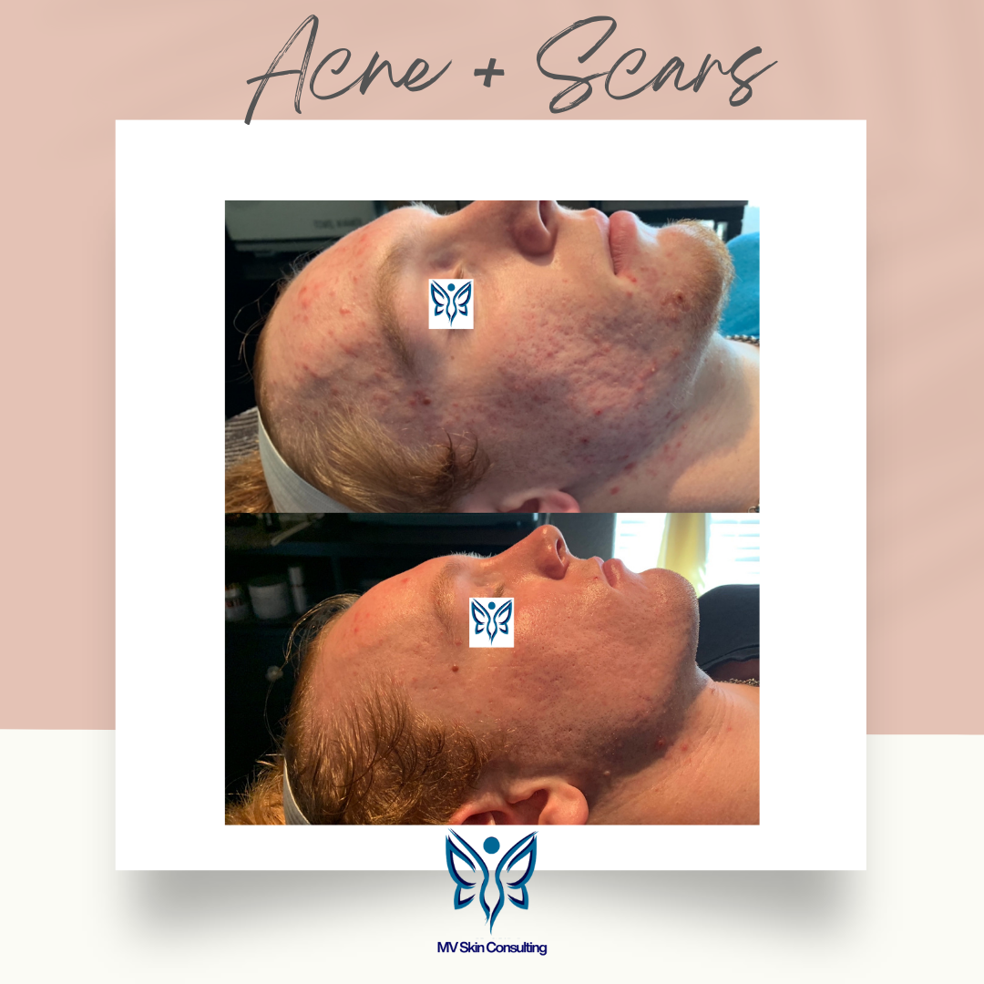 MV Skin Consulting healed acne scars naturally without harsh products near Richardson, TX
