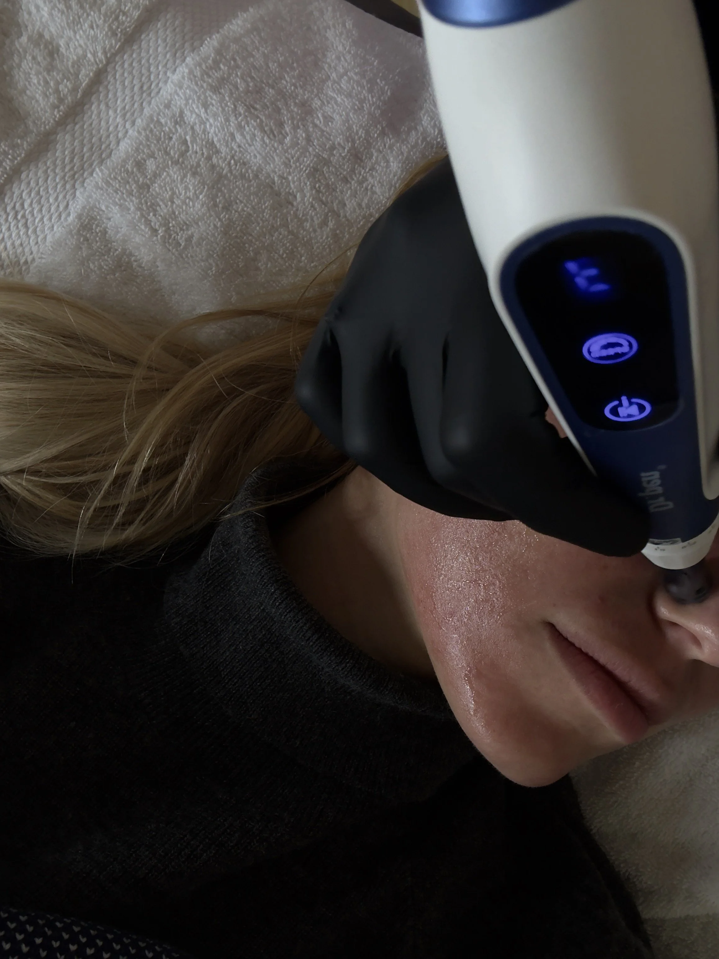A woman with long blonde hair lying down, receiving a skin treatment with a device used for microdermabrasion or facial therapy, while wearing a black glove.