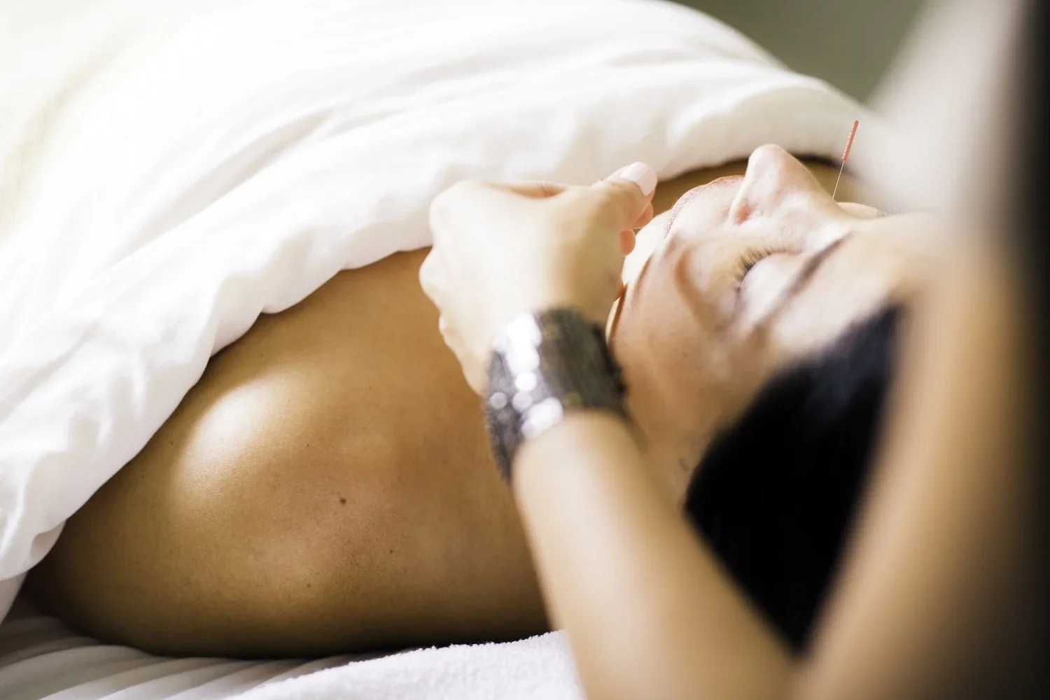 Acupuncture for PCOS in Campbell, CA — A Natural Approach to Hormonal Balance
