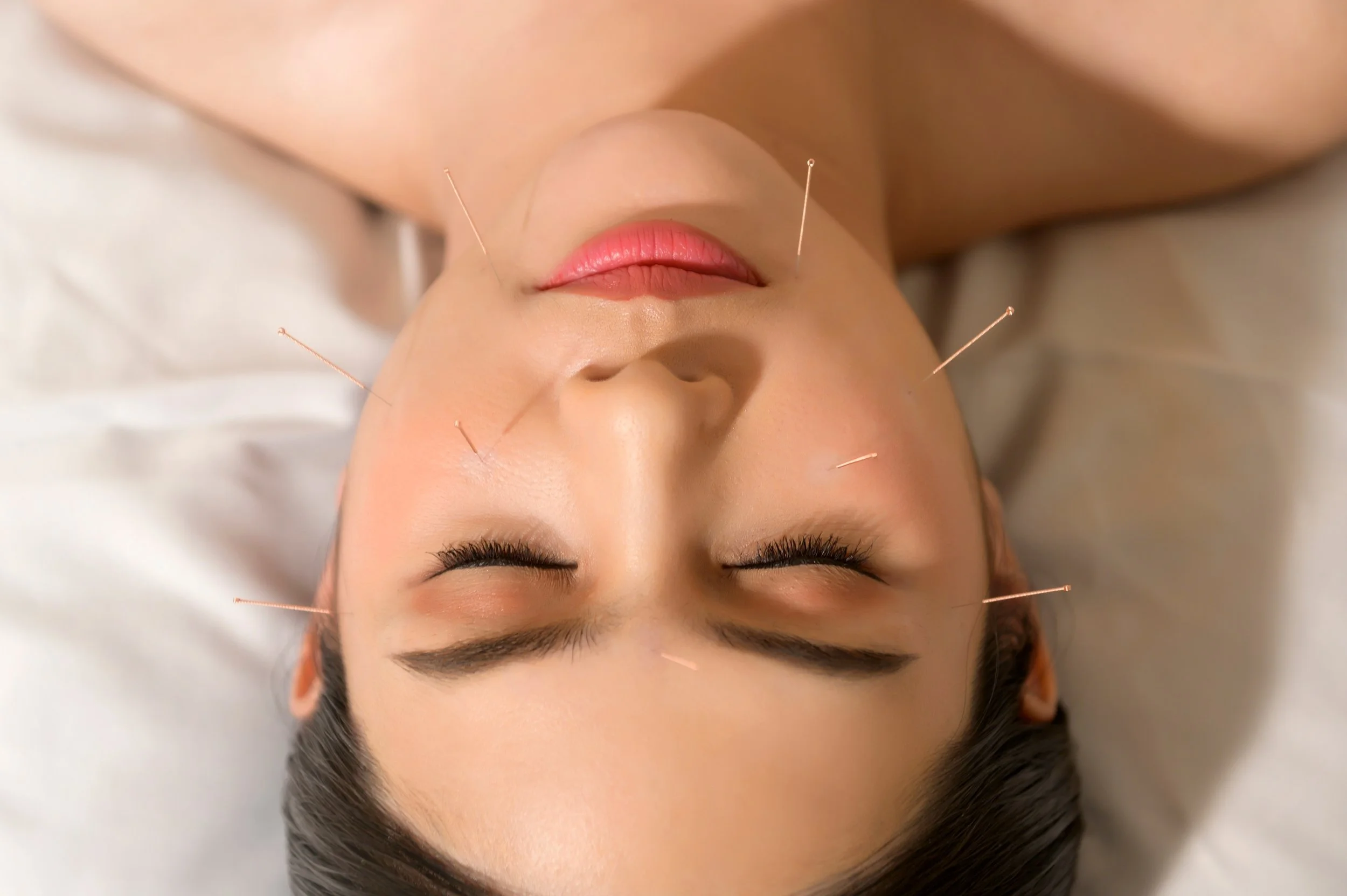Mai Acupuncture Facial in Campbell, CA