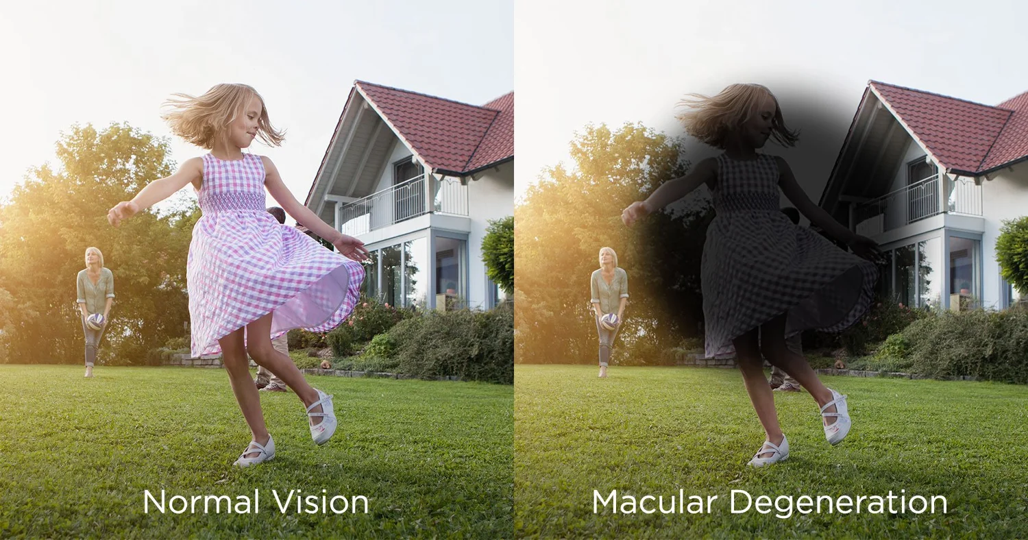 Macular Degeneration — Chino Hills Eye Care Center