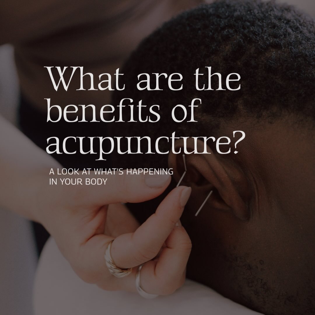 The benefits of acupuncture go beyond just pain relief! #acupuncture #tcm #hollistichealth