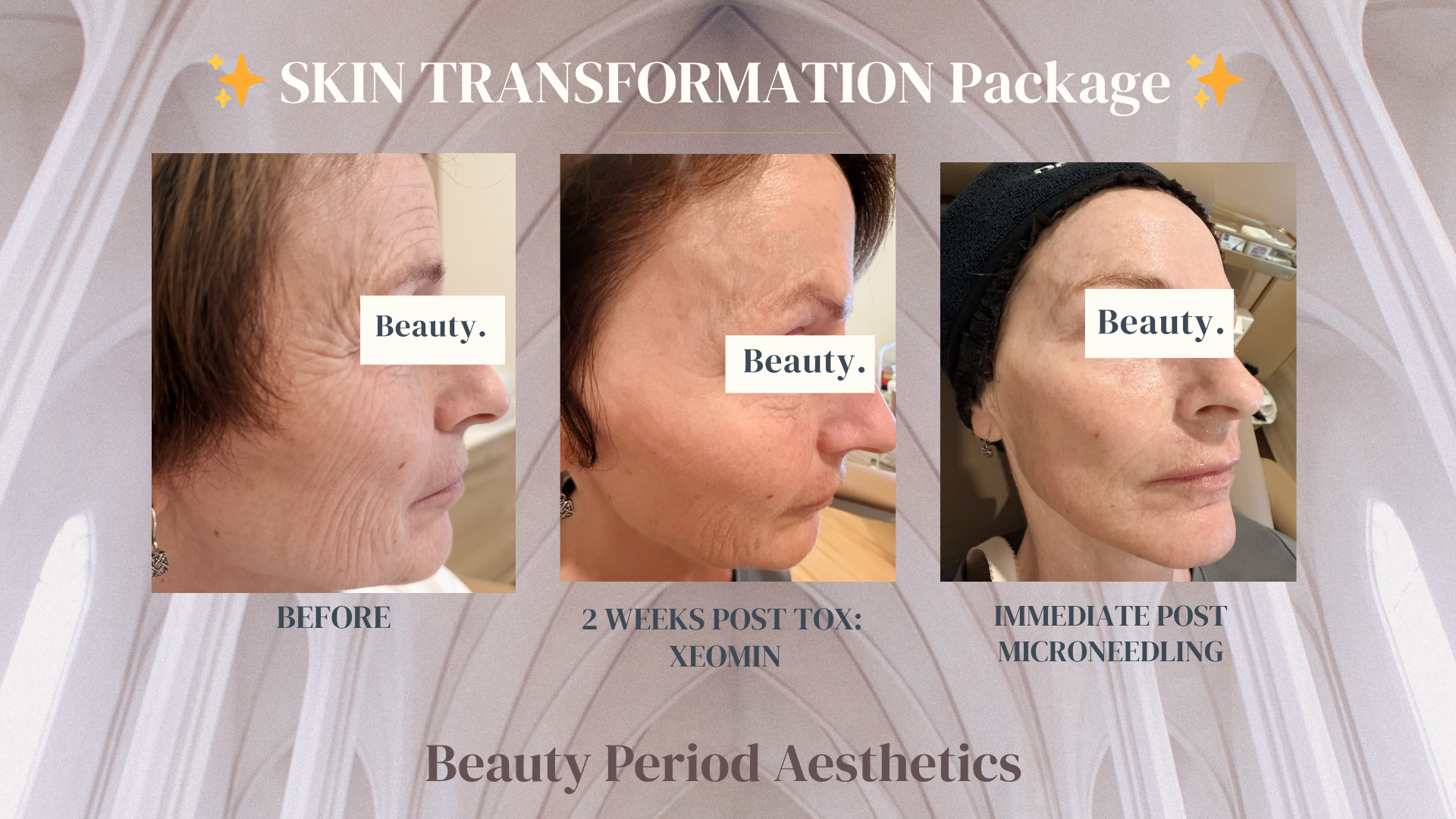 Skin Transformation: Why Botox Doesn’t Fully Fix Lines at Rest