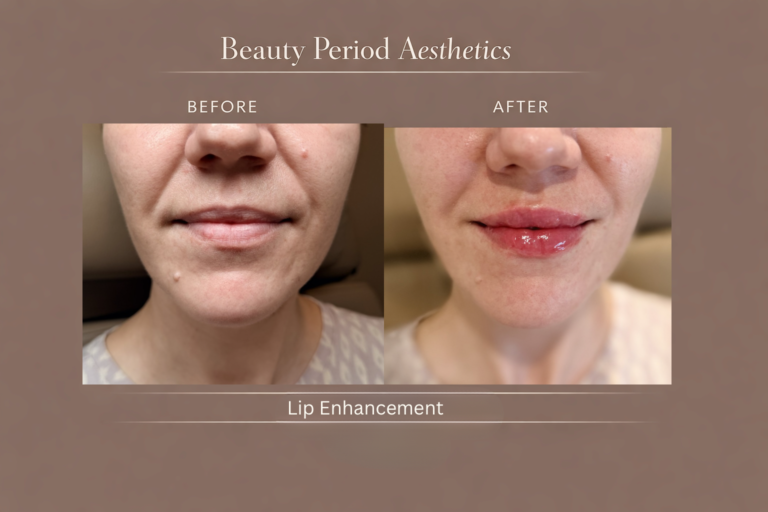 Subtle Lip Refinement with Lip Filler