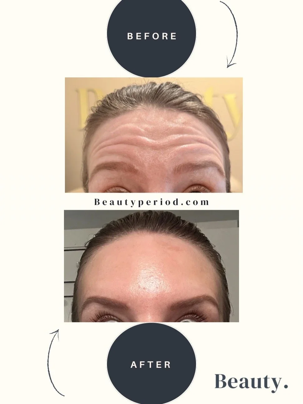 Before &amp; After: Forehead Softened, not Frozen