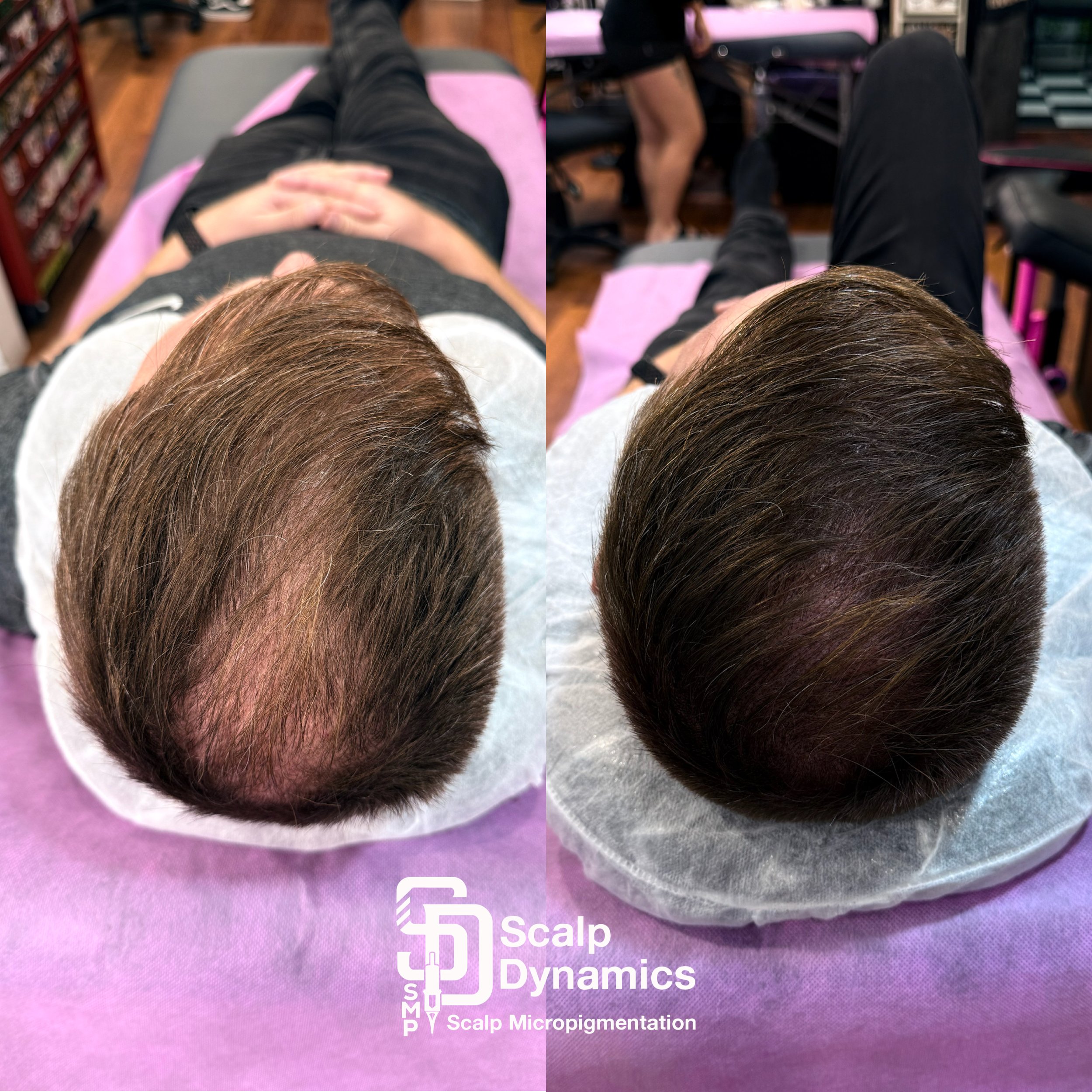 Side-by-side photos showing a person's top view of scalp. The left shows thinning hair with visible scalp, and the right shows fuller hair after scalp micropigmentation, with hair pigment create the appearance of thicker hair.