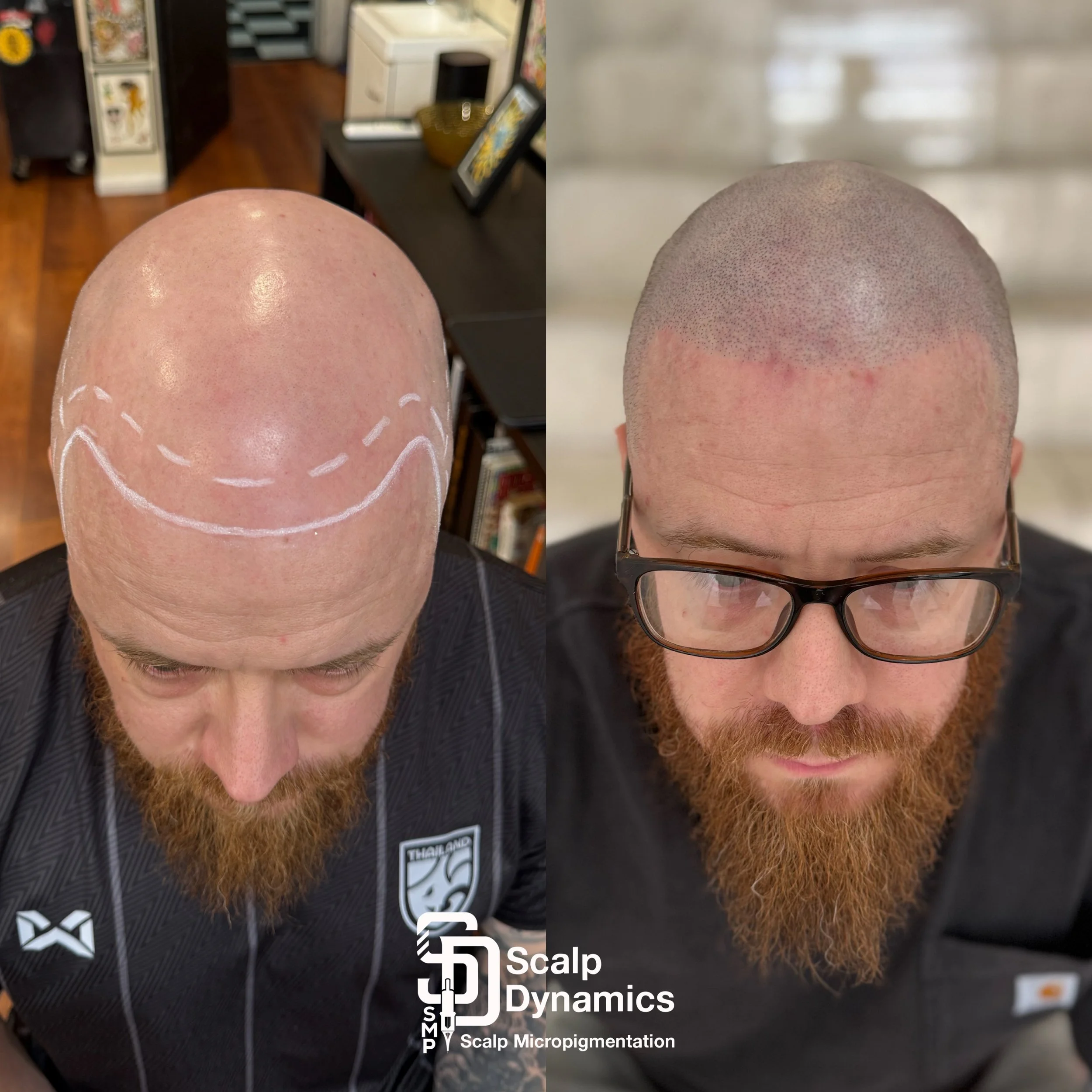 Comparison of a man's scalp before and after scalp micropigmentation; left side shows a bald scalp outlined with white chalk in a smiley face shape, right side shows the same scalp with tiny pigmentation dots creating the appearance of hair stubble.