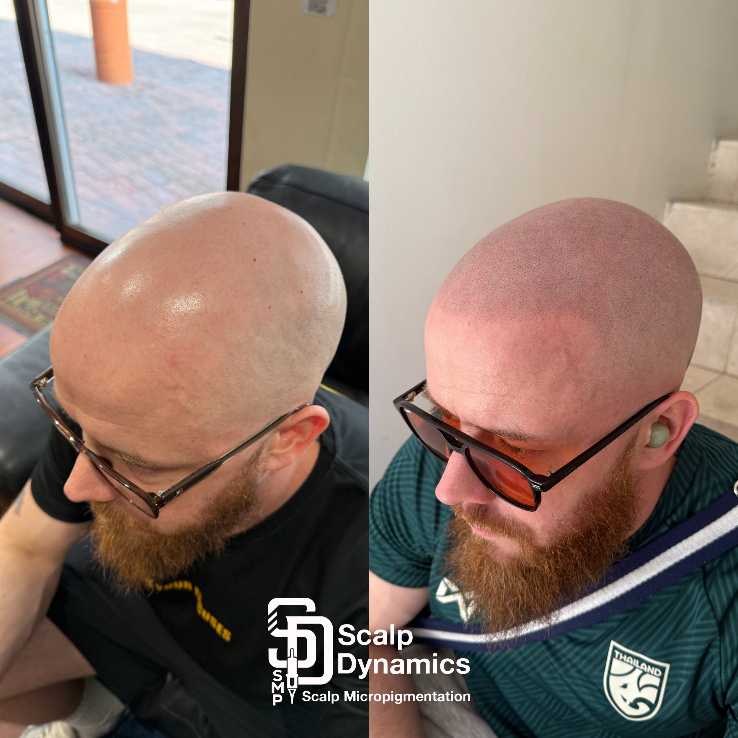 Comparison of a man's scalp before and after micropigmentation, showing a natural, shaved appearance with a darker, textured scalp surface in the after photo.