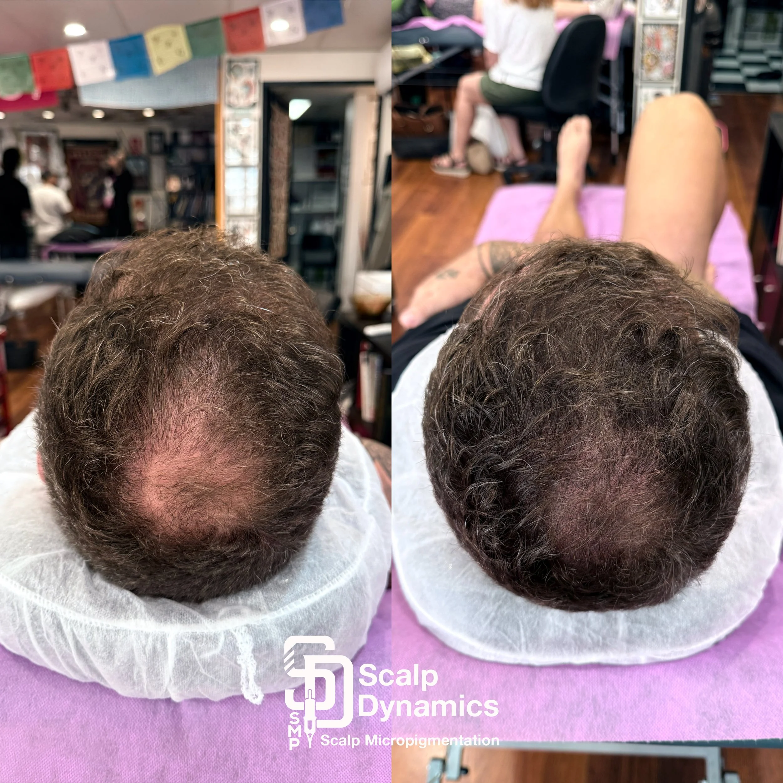 Comparison of a man's scalp before and after scalp micropigmentation treatment, showing coverage of the bald spot on the crown of the head.