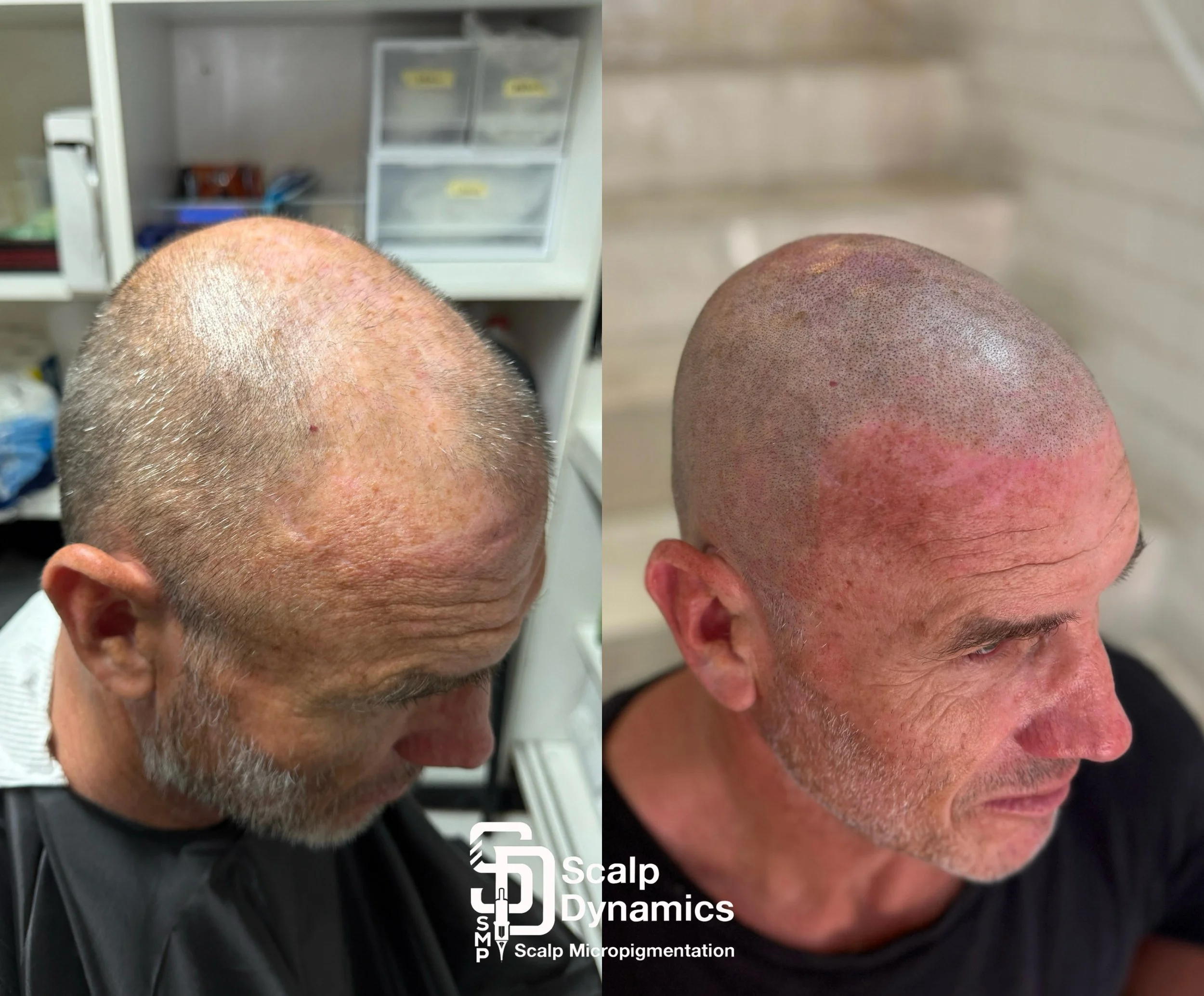 Side-by-side comparison of a man's scalp before and after scalp micropigmentation treatment. The left shows a thinning, bald scalp with scars, and the right shows a fuller appearance with tiny pigment dots mimicking hair follicles.