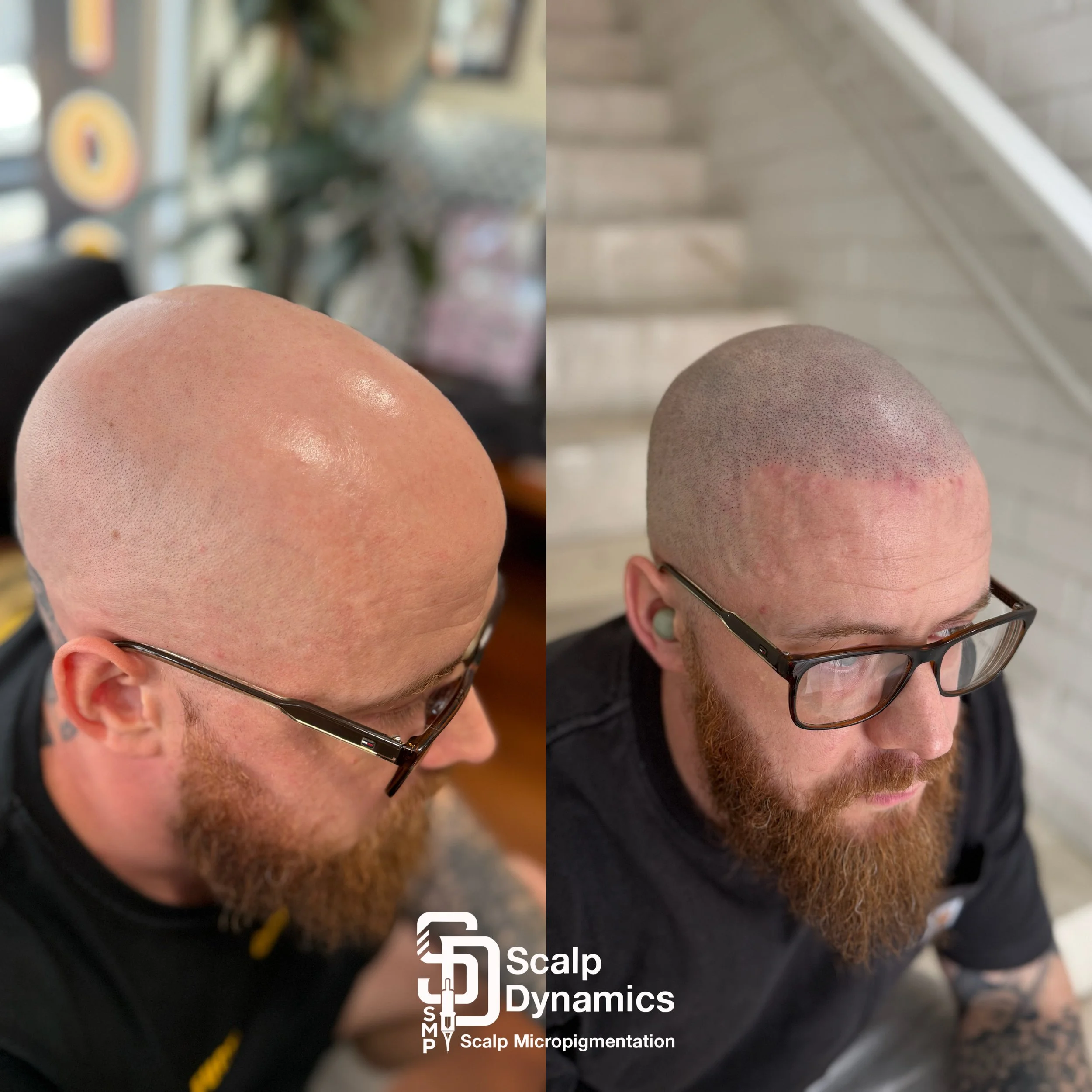 Side-by-side photos of a man with a beard and glasses, showing his scalp before and after scalp micropigmentation. The left image shows a bald scalp, and the right image shows a scalp with a simulated hair follicle pattern. The logo and text 'Scalp D