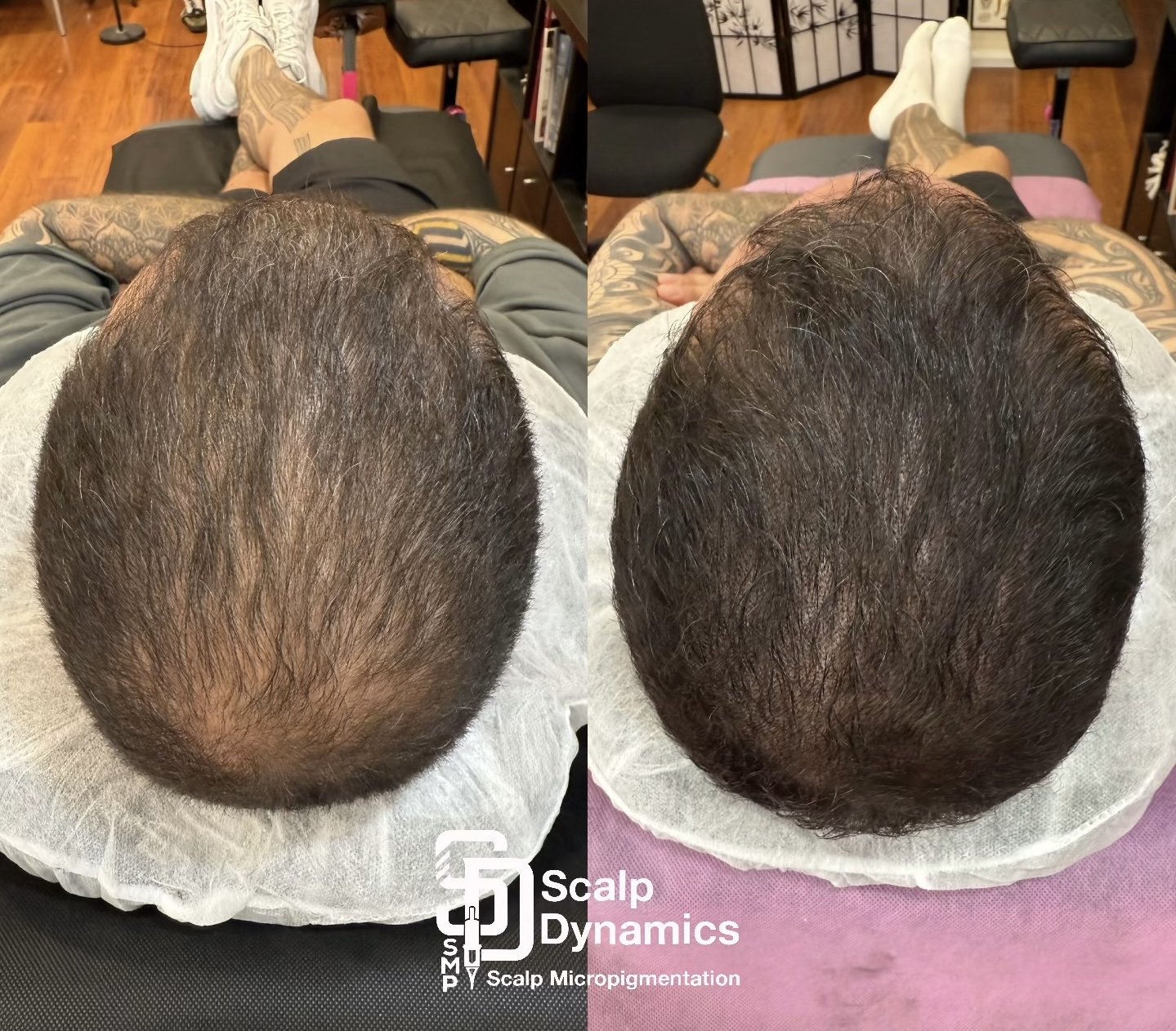 Side-by-side comparison of a man's scalp before and after scalp micropigmentation, showing increased hair density, with the logo and text 'Scalp Dynamics - Scalp Micropigmentation' at the bottom.