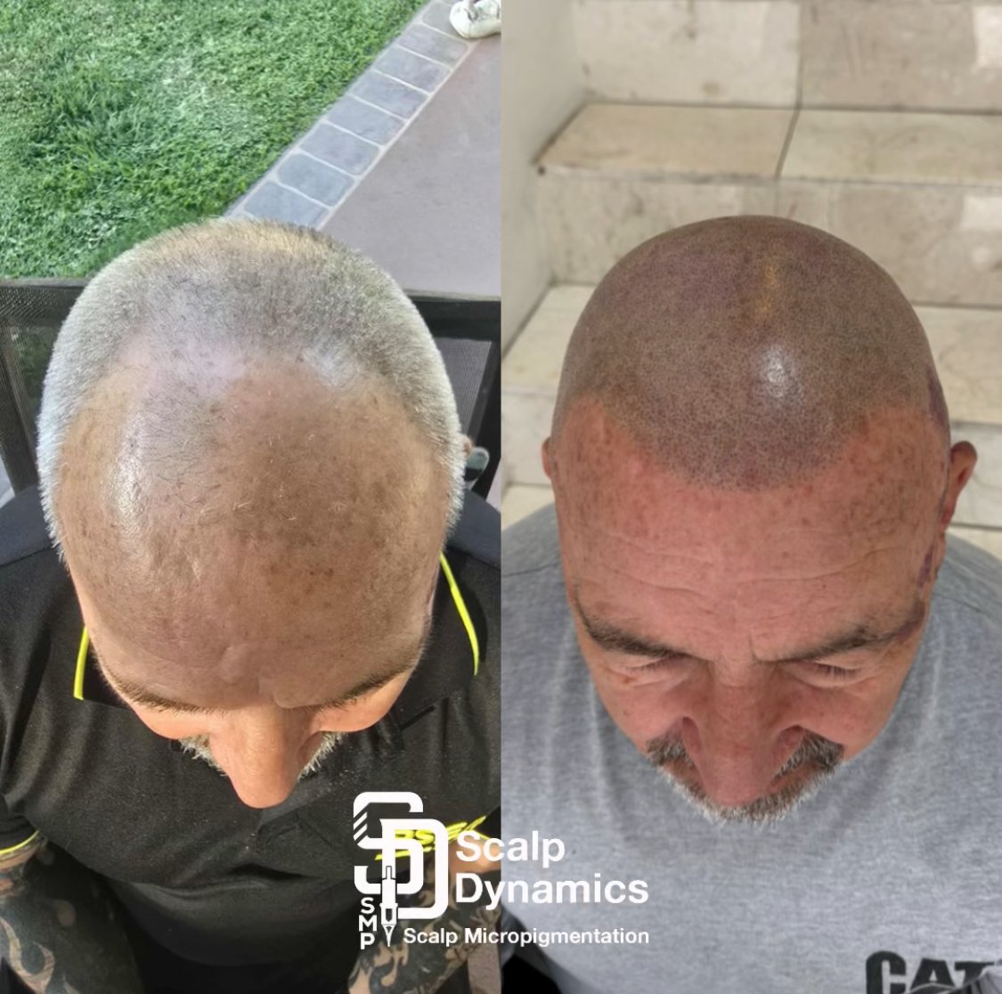 Comparison of a man's scalp before and after scalp micropigmentation treatment, showing a filled-in and darker hair follicle pattern on the right.