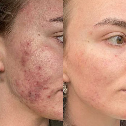 Blue--NIR--12-Flex-MD-Treatments--12-Weeks--Courtesy-of-Lime-Beauty-Co--NSW.png