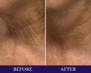 CHIN & NECK:  Jaw Sculpt/Loose Skin