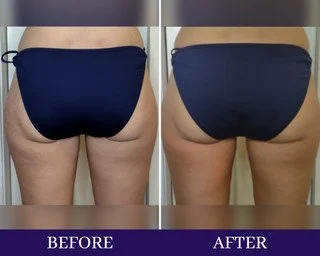 LEGS:  Glute Contouring (Butt Lift)