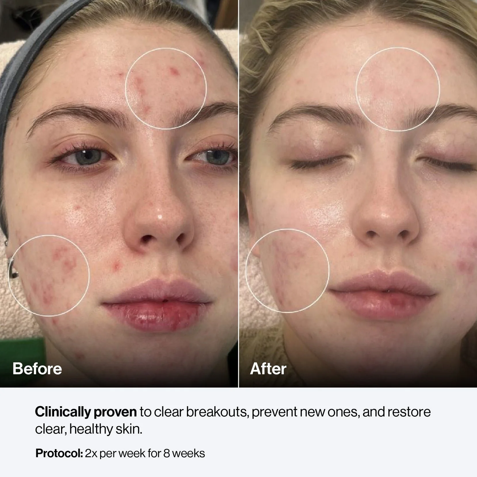 celluma-contour-plus-5-mode-led-red-light-therapy-panel-before-after-acne-3-2000x2000.jpg