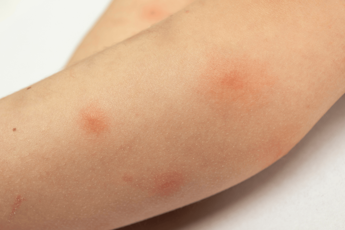 mosquito bite vs bed bug bite