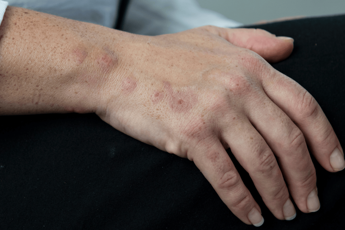 mosquito bite vs bed bug bite