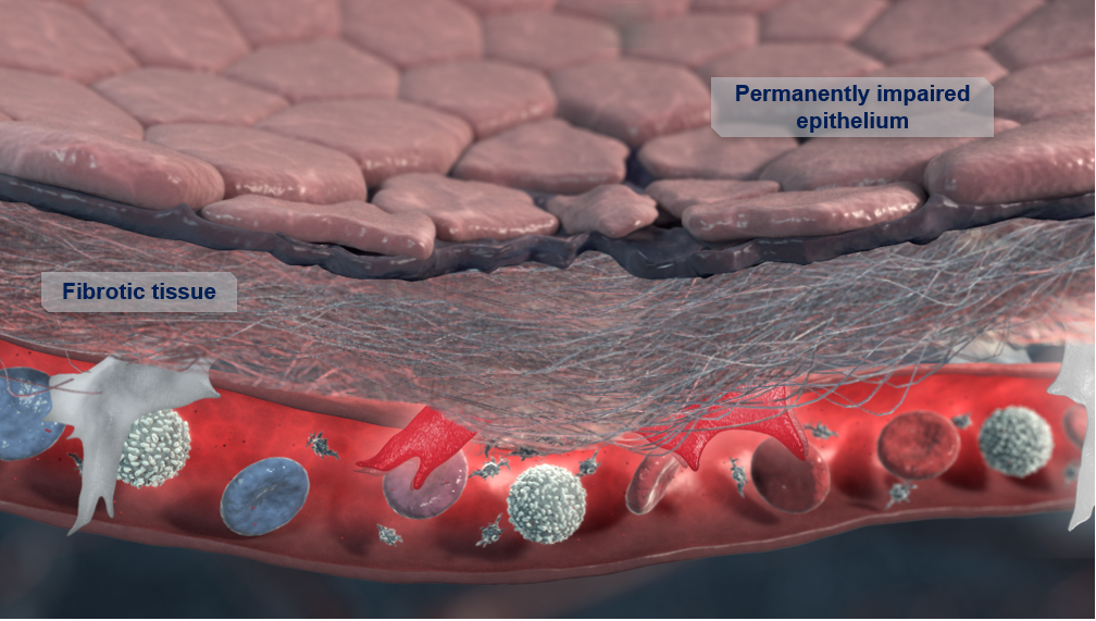 Close-up illustration of inflamed skin tissue with impaired epithelium, fibrotic tissue, and blood cells.