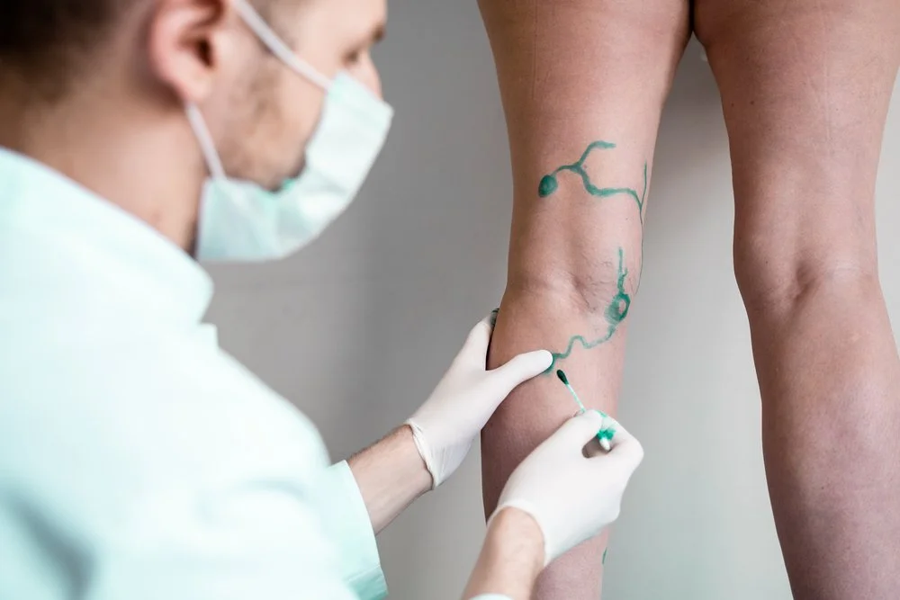 Doctor using a green marker to outline varicose veins on a patient's leg
