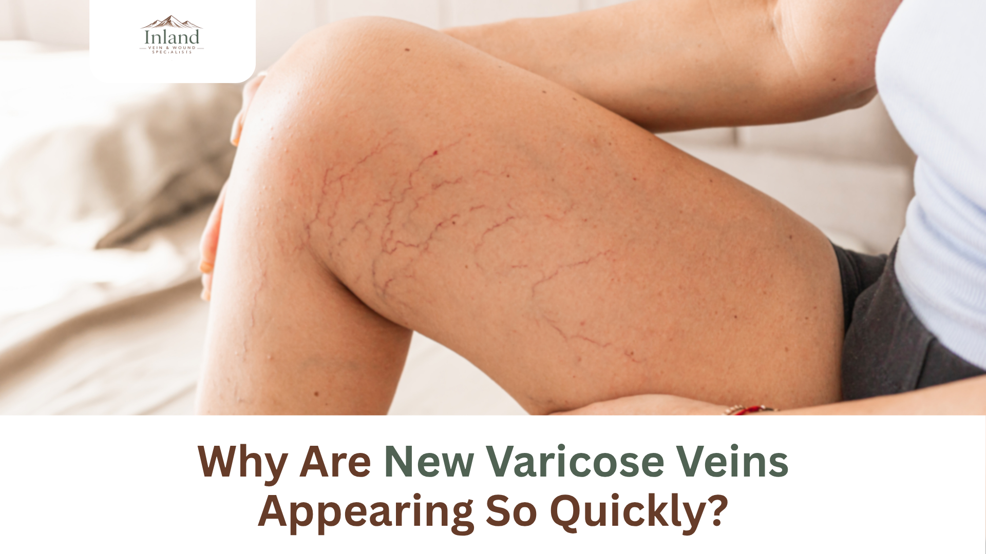 Why Are New Varicose Veins Appearing So Quickly?