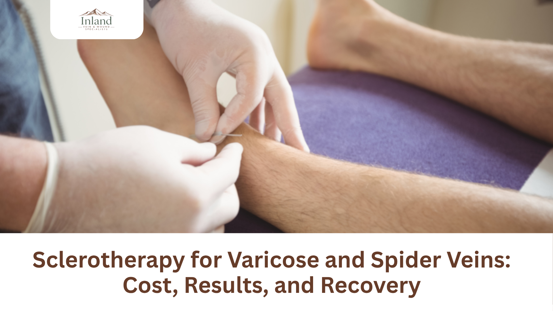 Sclerotherapy for Varicose and Spider Veins: Cost, Results, and Recovery