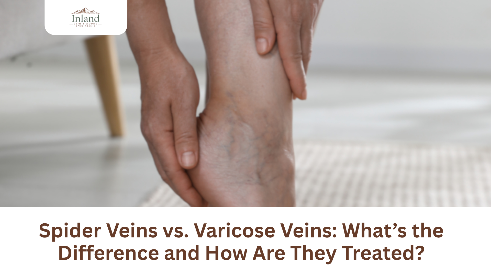 Spider Veins vs. Varicose Veins: What’s the Difference and How Are They Treated?