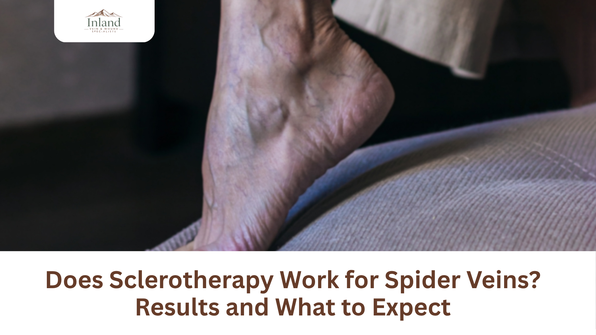 Does Sclerotherapy Work for Spider Veins? Results and What to Expect