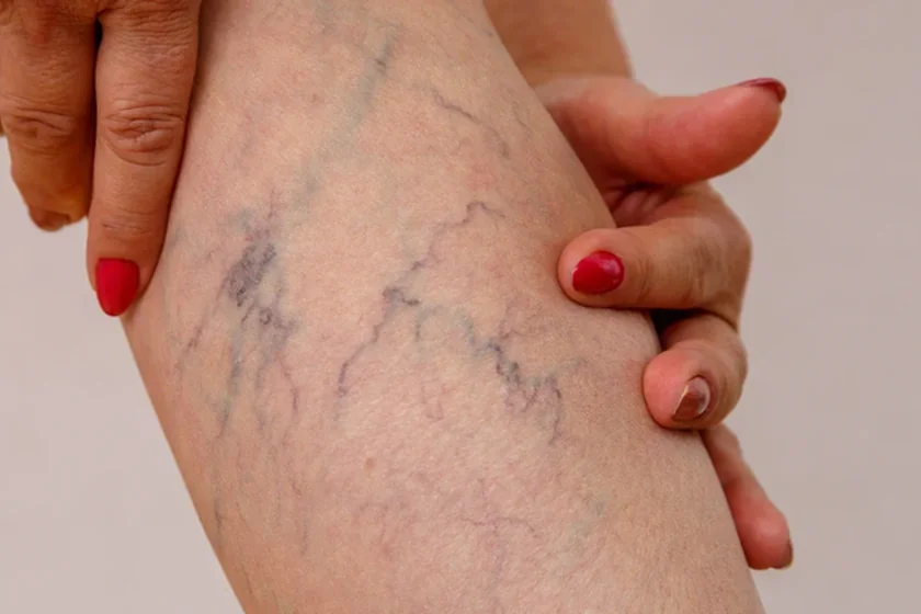 Visible veins on a person's lower leg.