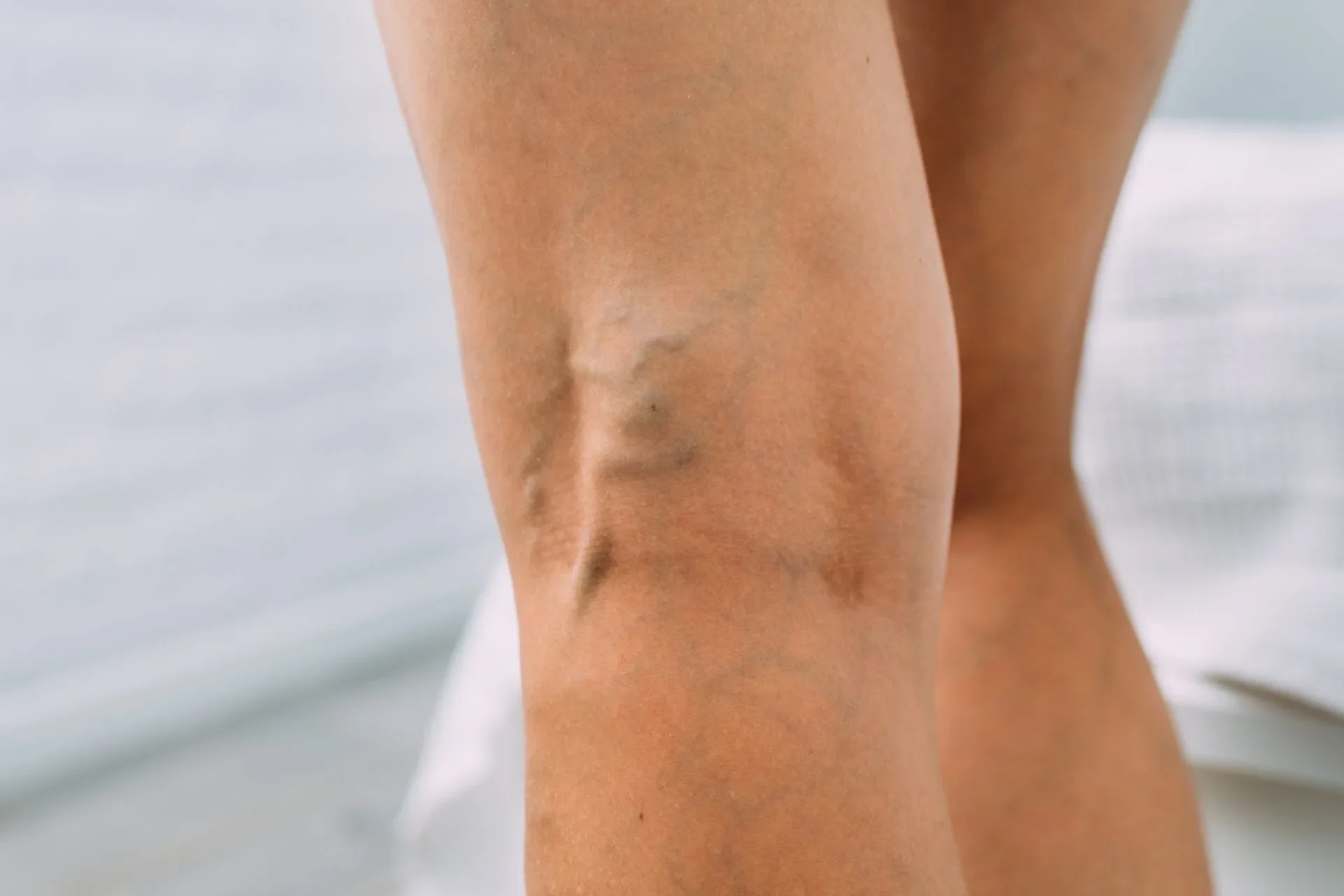 Close-up view of prominent, twisted, and bulging varicose veins visible on the back of a patient's leg 