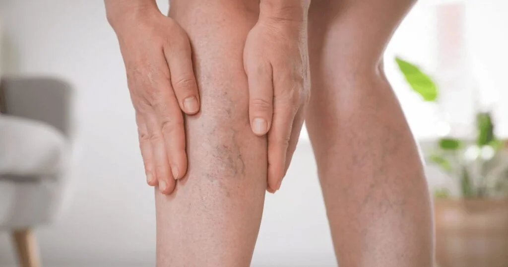 Person touching their lower leg where varicose veins are visible.