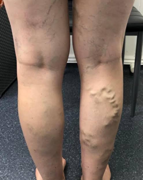 Varicose veins visible on both legs.
