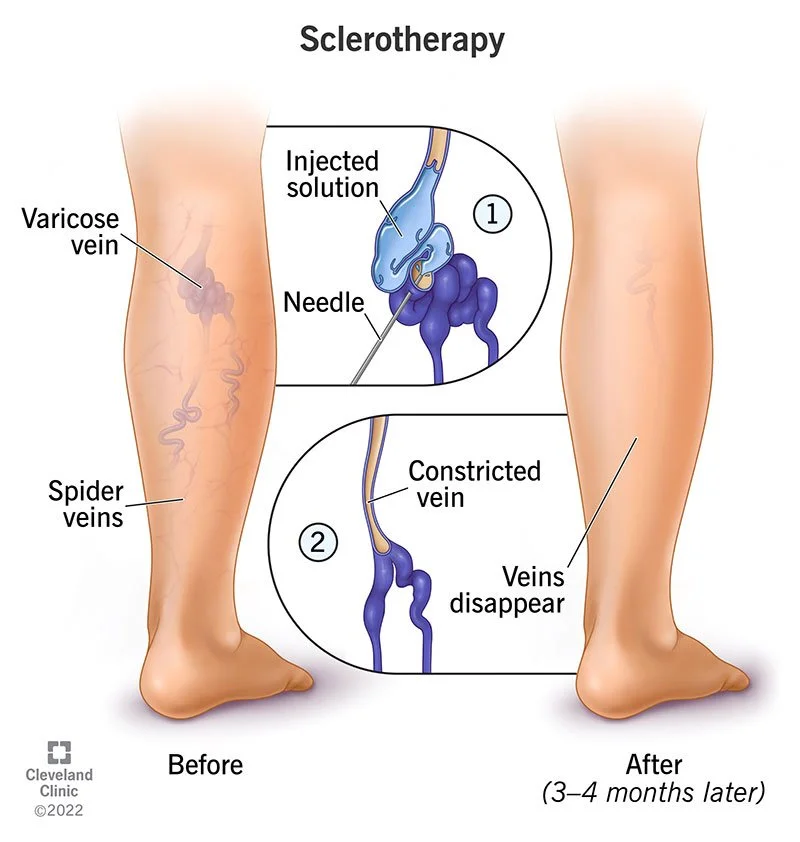 Illustration showing the process of sclerotherapy to treat varicose veins. The before side shows spider veins and varicose veins, while the after side shows veins disappearing after treatment. The inset diagrams depict the injection of a solution into a vein, causing it to constrict and eventually disappear.