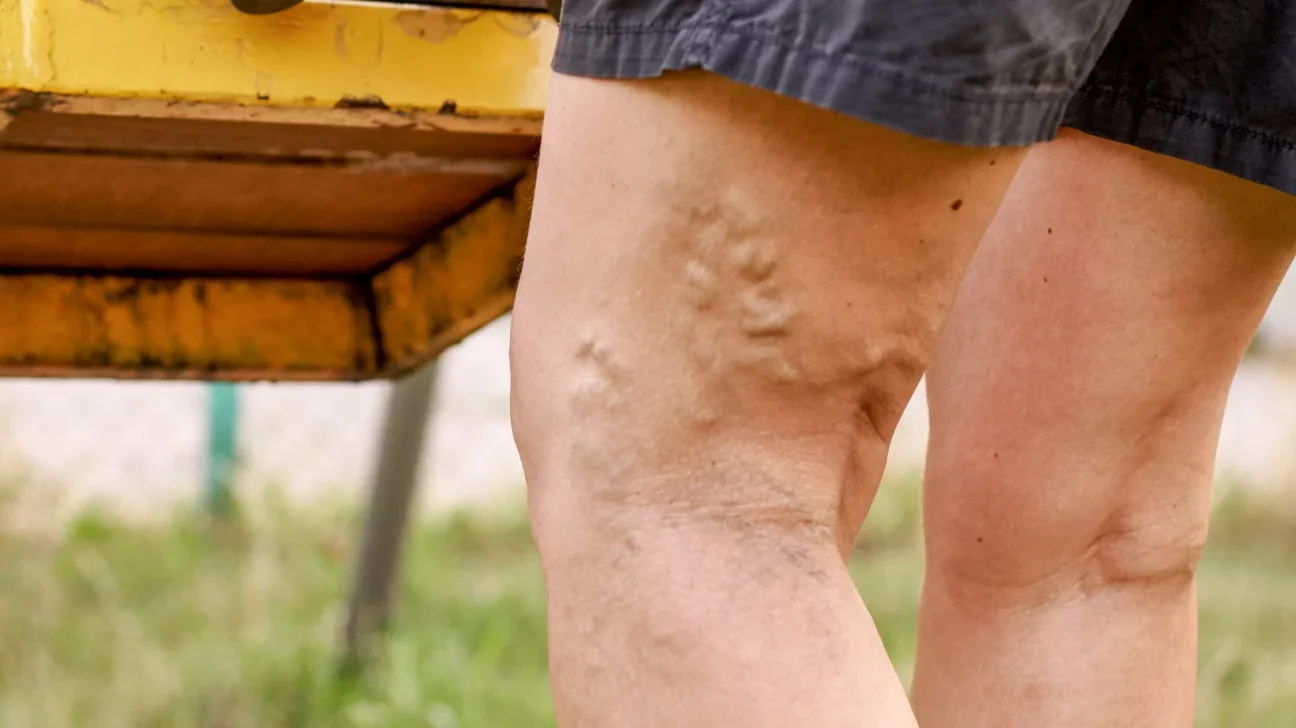 Alt text: Leg with visible varicose veins, highlighting a common vascular condition. 
