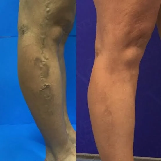 Side-by-side before and after photo showing prominent varicose veins on a calf fully resolved following medical treatment