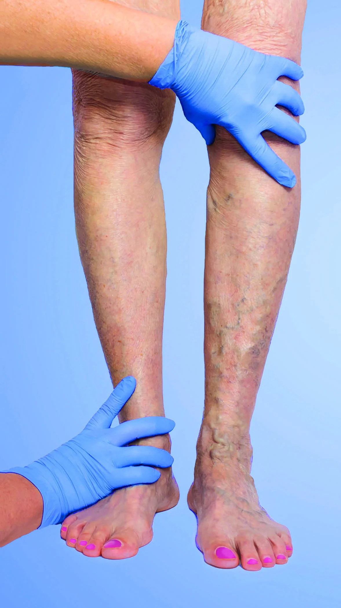 Doctor wearing blue gloves conducting a physical examination of a patient's lower legs affected by varicose veins 