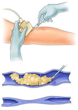 Medical procedure where a doctor injects a substance into a patient's arm, with a close-up of the injection site and a tray of filled syringes or medical equipment.