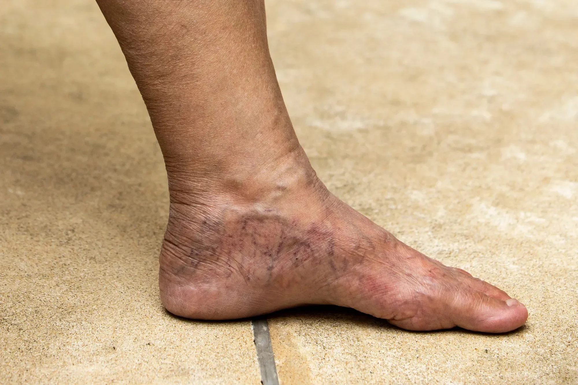 Varicose veins visible on a person's feet and lower legs.