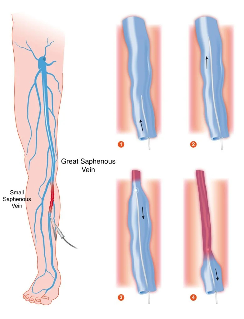 Diagram showing the process of a medical procedure involving the great and small saphenous veins, with four steps illustrating the insertion and movement within a vein.