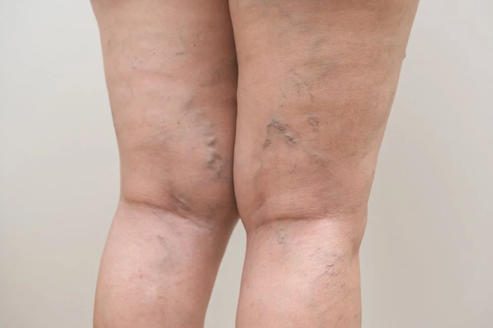 Close-up of a person's legs with visible skin discoloration.