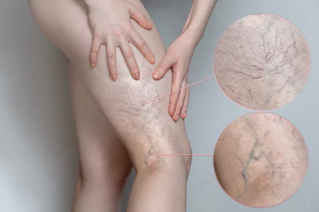 Medical illustration highlighting vascular conditions with zoomed-in circles showing fine thread veins and larger bulging veins 