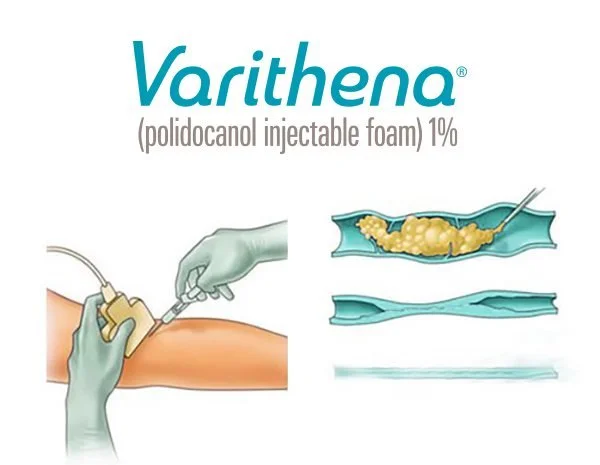Graphic of a medical injection being administered into a person's arm, with illustrations of the foam being injected and the syringe used for Varithena, a polidocanol injectable foam medication.