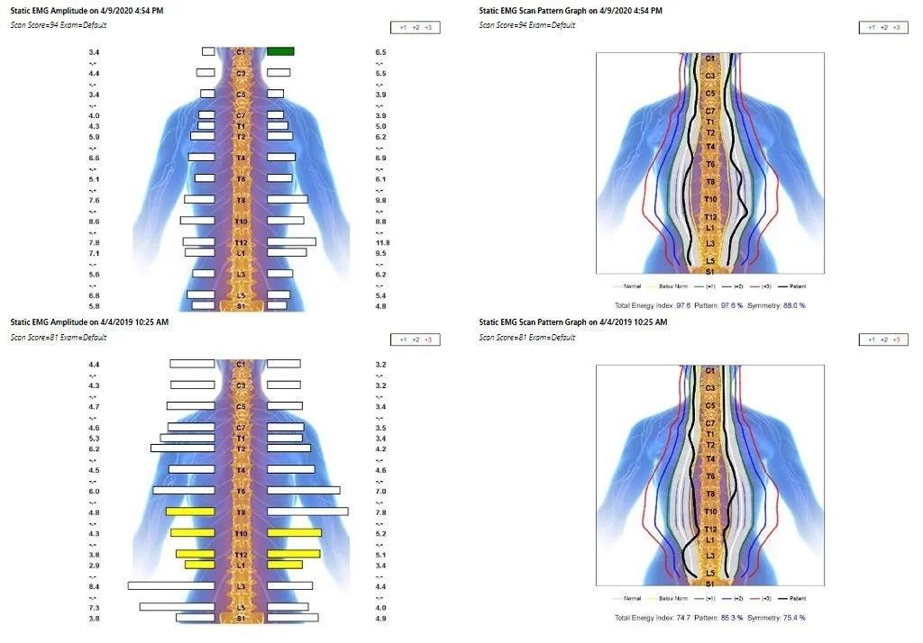 CLA INSiGHT scan results showing spinal assessment chart for athletic performance in Liberty MO