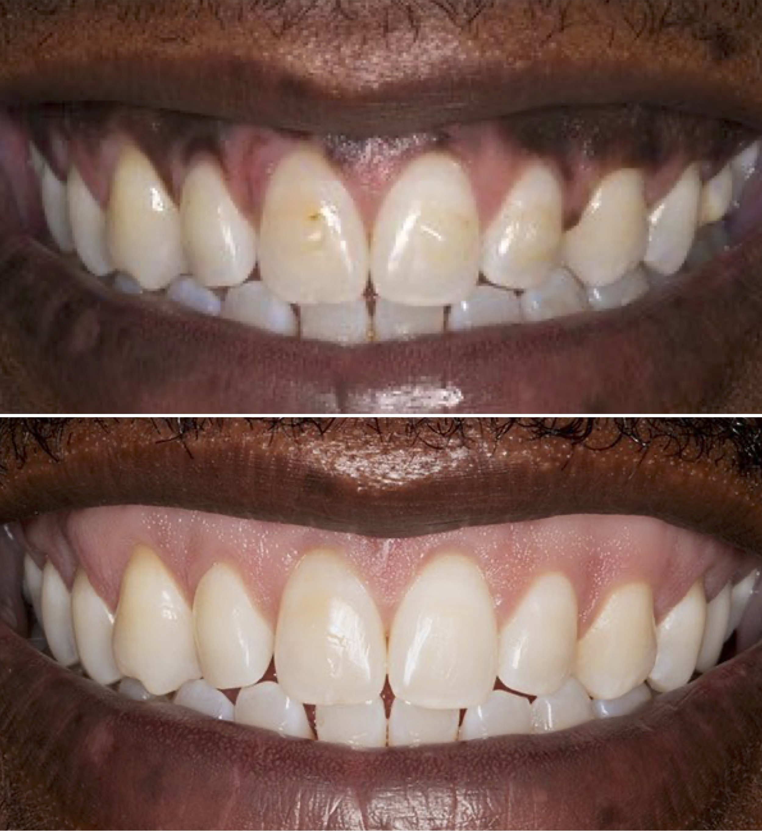 Cosmetic dentistry - Laser gum lightening at ORA in Chicago
