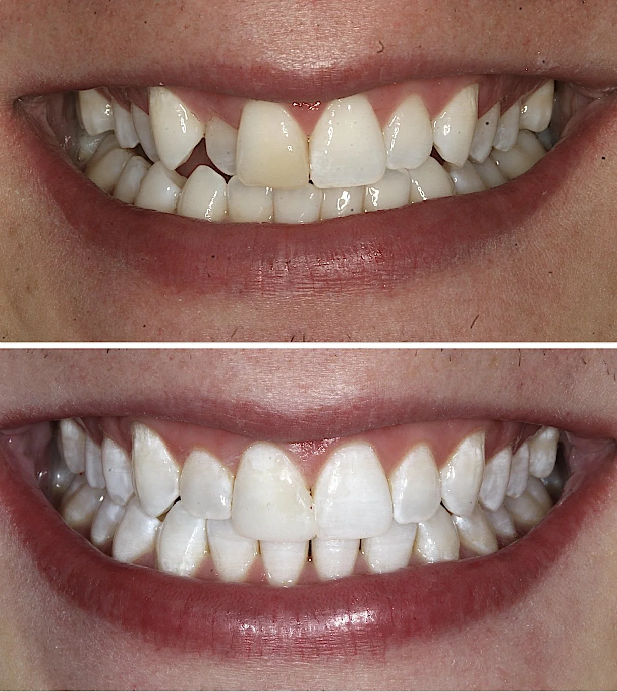 Cosmetic dentistry - Invisalign at ORA in Chicago