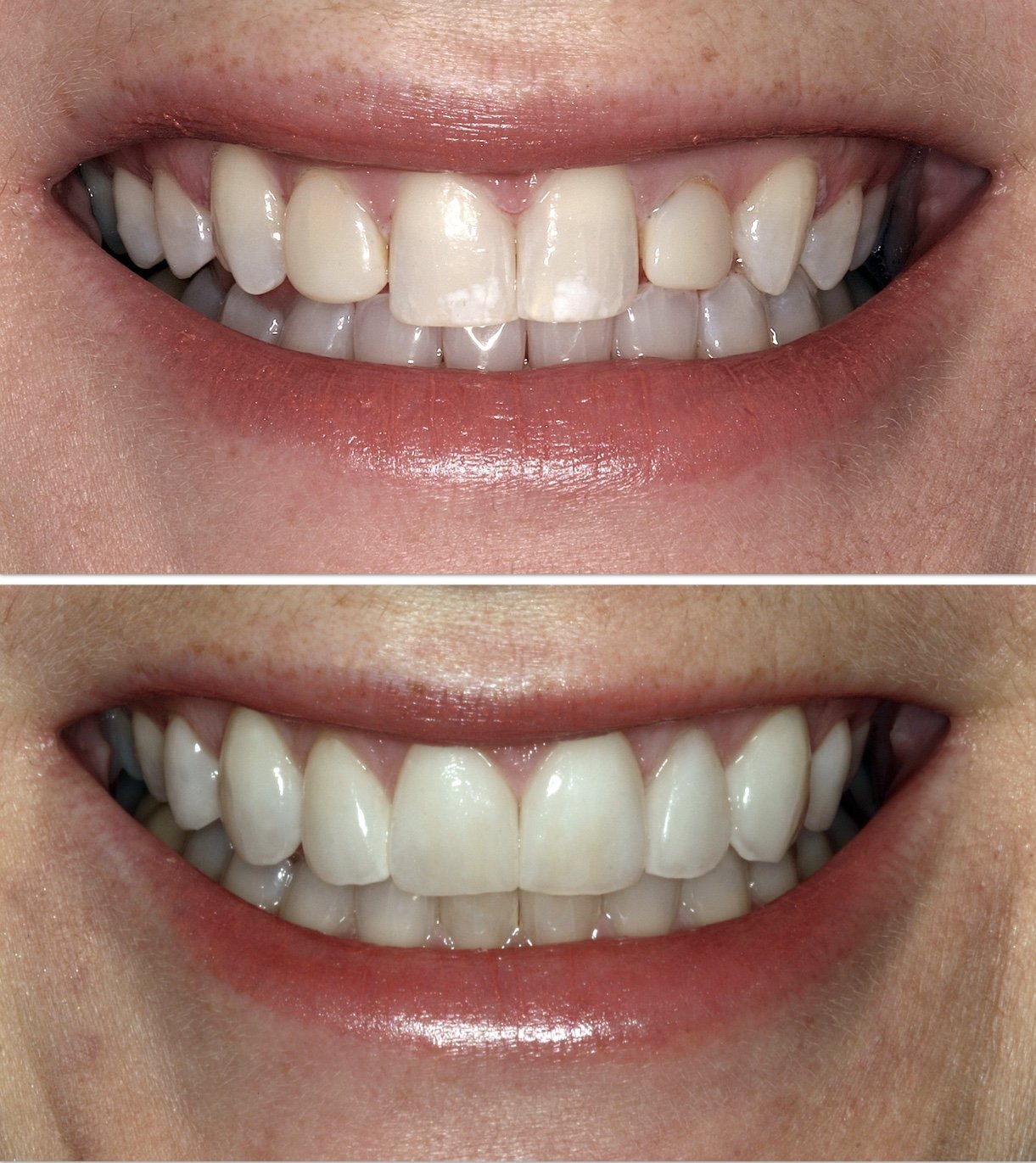 Cosmetic dentistry - 3DVNR™ No Prep 3D Printed Porcelain Veneers at ORA in Chicago
