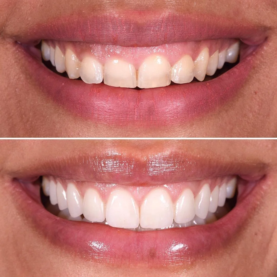 Cosmetic dentistry - Laser gim contouring at ORA in Chicago